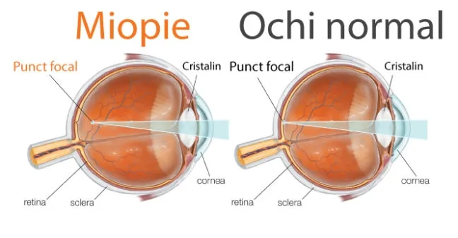 Miopie generalizată