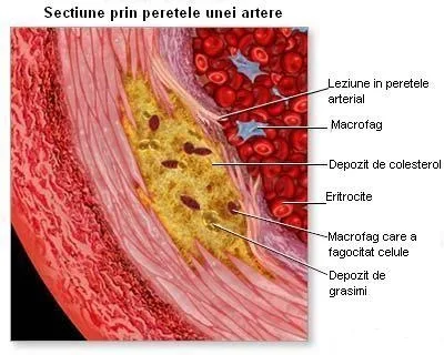 Ateroscleroza, o boală care evoluează "în tăcere"