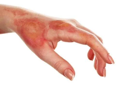 Arsurile, domestic sau nu, oricum un accident nefericit
