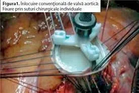 Premieră la Spitalul Militar “Carol Davila” – implant de valvă aortică Sutureless