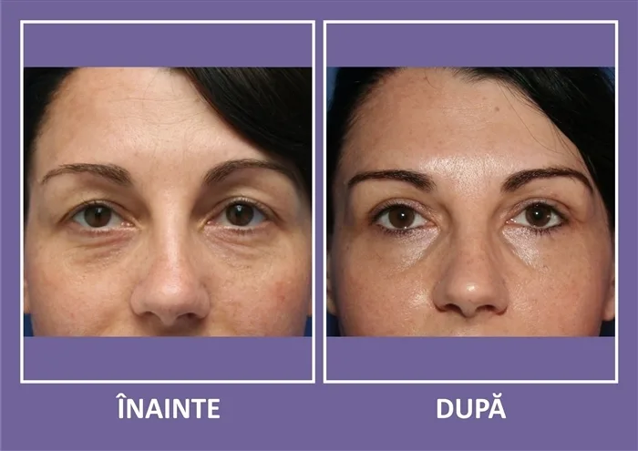 Blefaroplastia