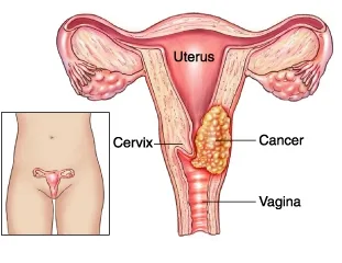 Cancerul de col uterin