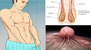Hormonii androgeni responsabili pentru cancerul la bărbaţi