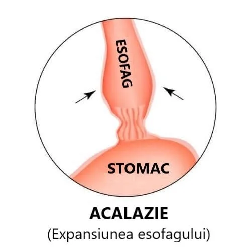 Acalazia
