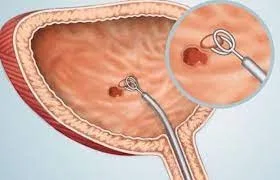 Un nou medicament în lupta împotriva cancerului