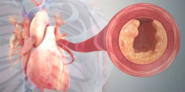 Bolile cardiovasculare, principala problemă de sănătate în lume