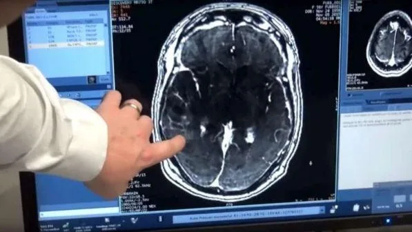 Un medicament pentru tumorile cerebrale