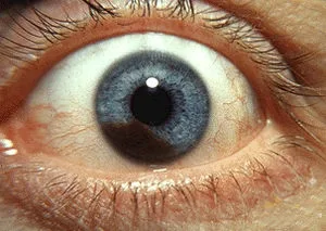 Melanomul uveal