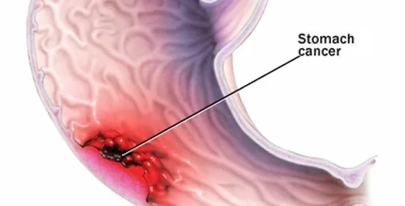 Cancerul gastric