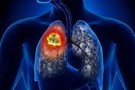 Cancerul pulmonar