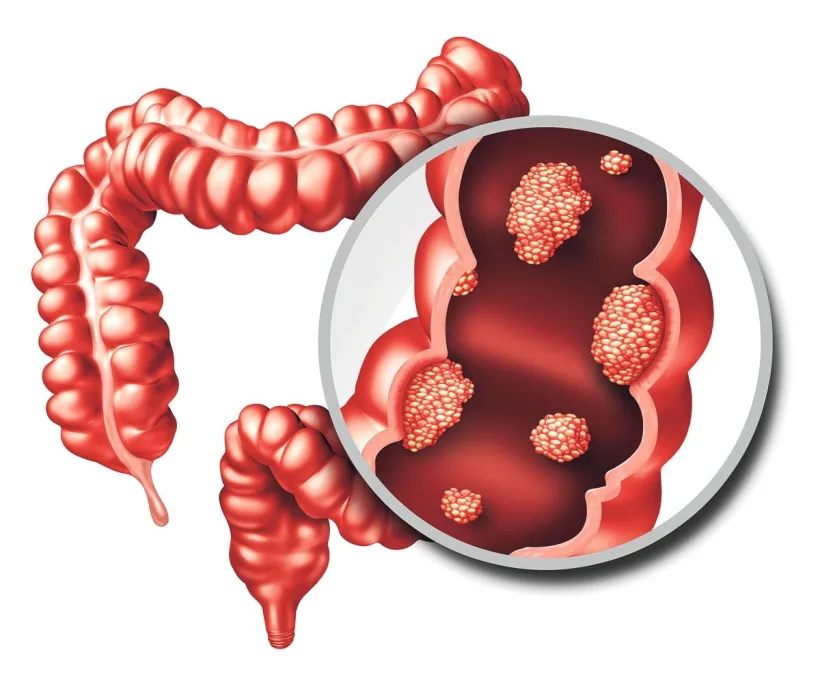 Studii pentru a impiedica recidiva cancerului de colon