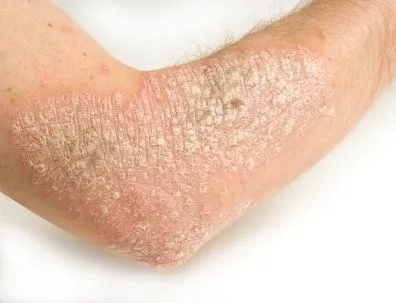 Lidocaina împotriva psoriazisului