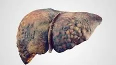 Cancerul hepatic ar putea fi oprit