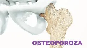 Osteoporoza şi Vitamina D