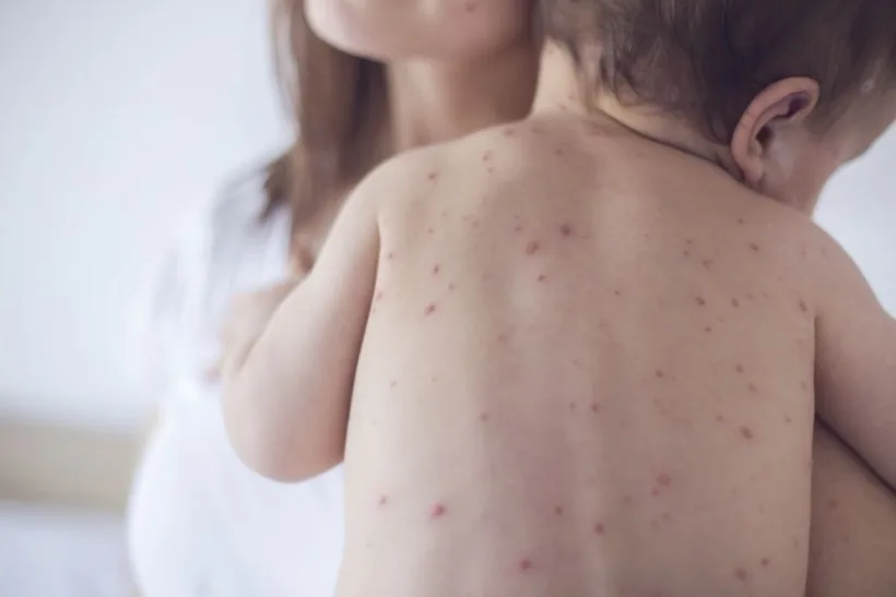 Peste 1.000 de cazuri de rujeolă înregistrate în luna mai