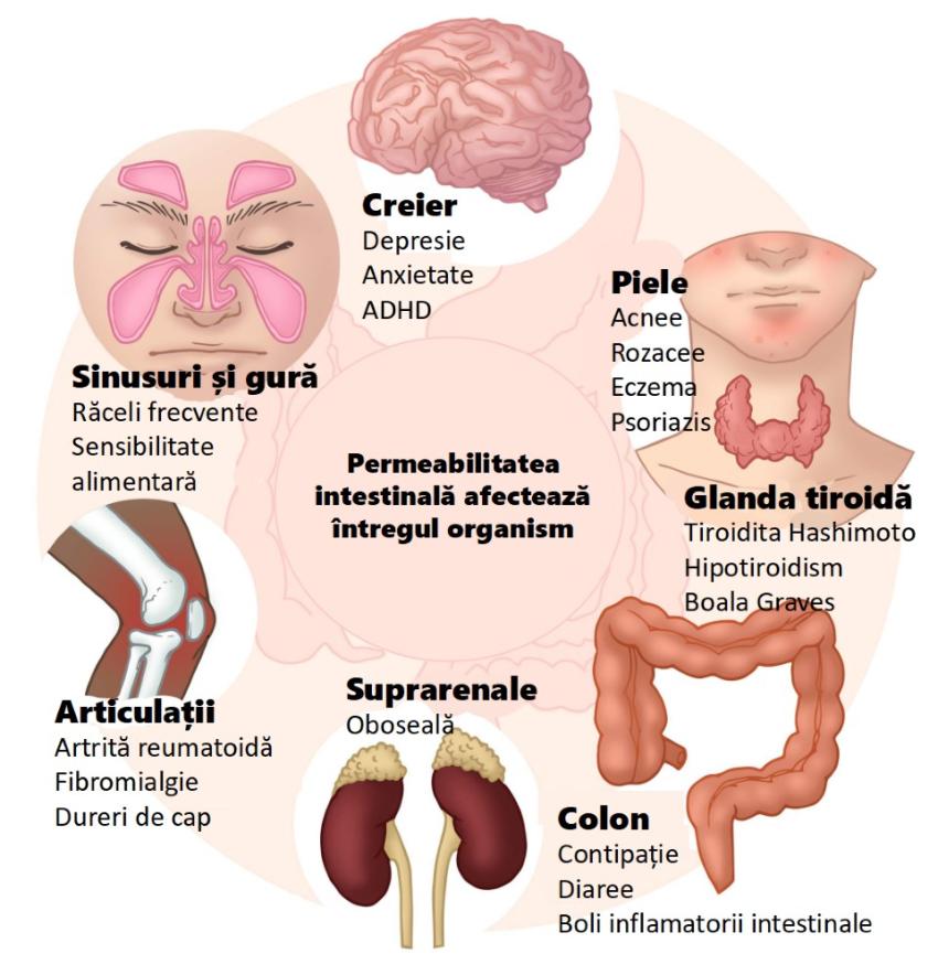 Dieta ”occidentală” duce la creșterea cazurilor de boli autoimmune în rândul populației