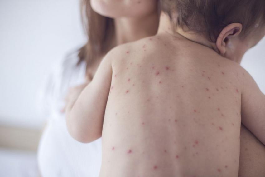 Peste 1.000 de cazuri de rujeolă înregistrate în luna mai