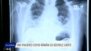 Coronavirus: 40% dintre cei care au trecut prin COVID-19 suferă sechele de lungă durată (studiu)