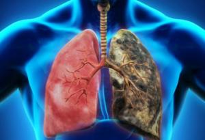 7 lucruri pe care trebuie să le știi despre cancerul pulmonar