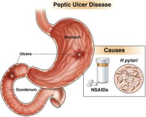 27 ulcer